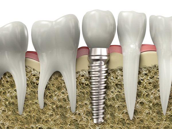 Implantologia Dental Gallery